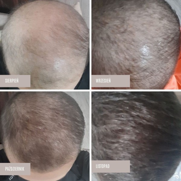 Hair serum - Hair growth product