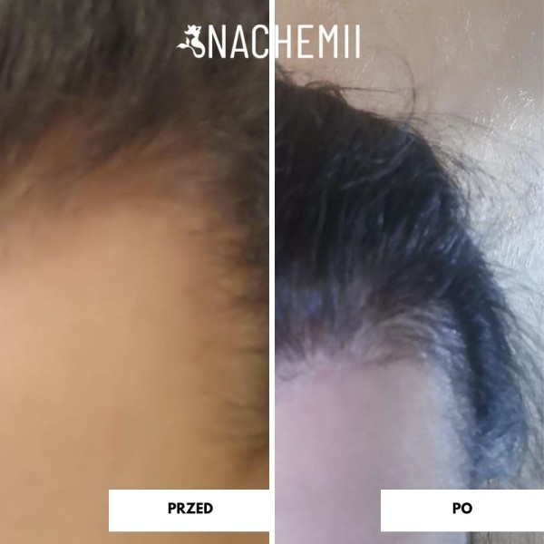 Hair serum - Hair growth product