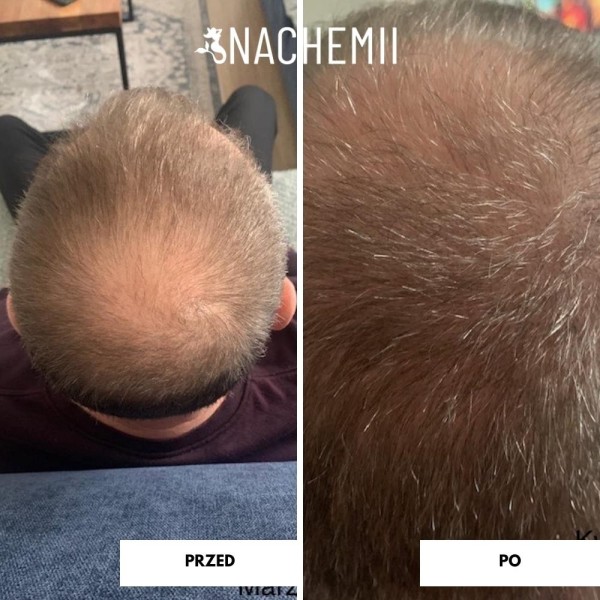 Hair serum - Hair growth product