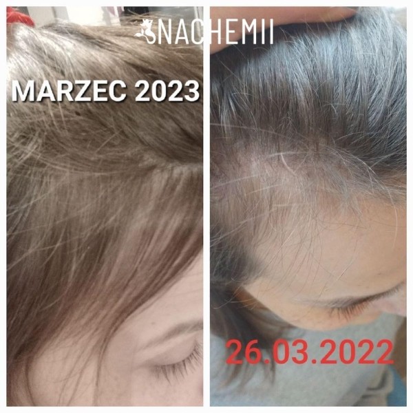 Hair serum - Hair growth product