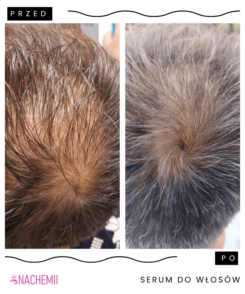 Hair growth serum - for men - online store